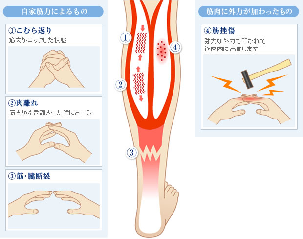 肉離れ